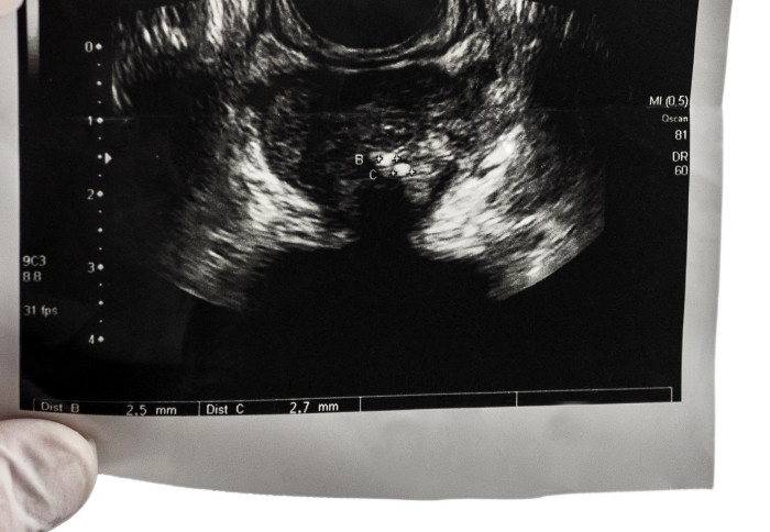 Prostate ultrasound
