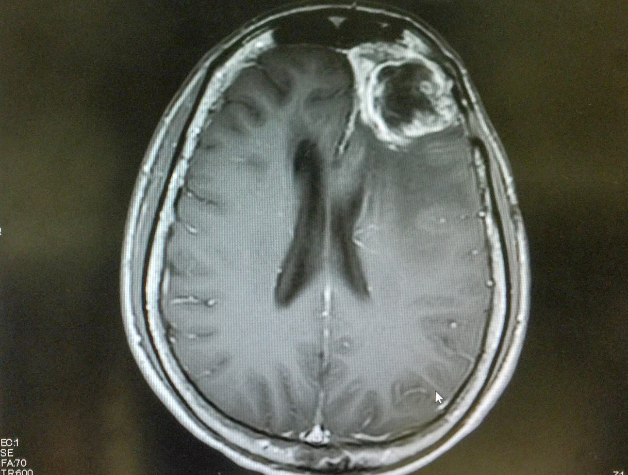 An MRI of a human brain