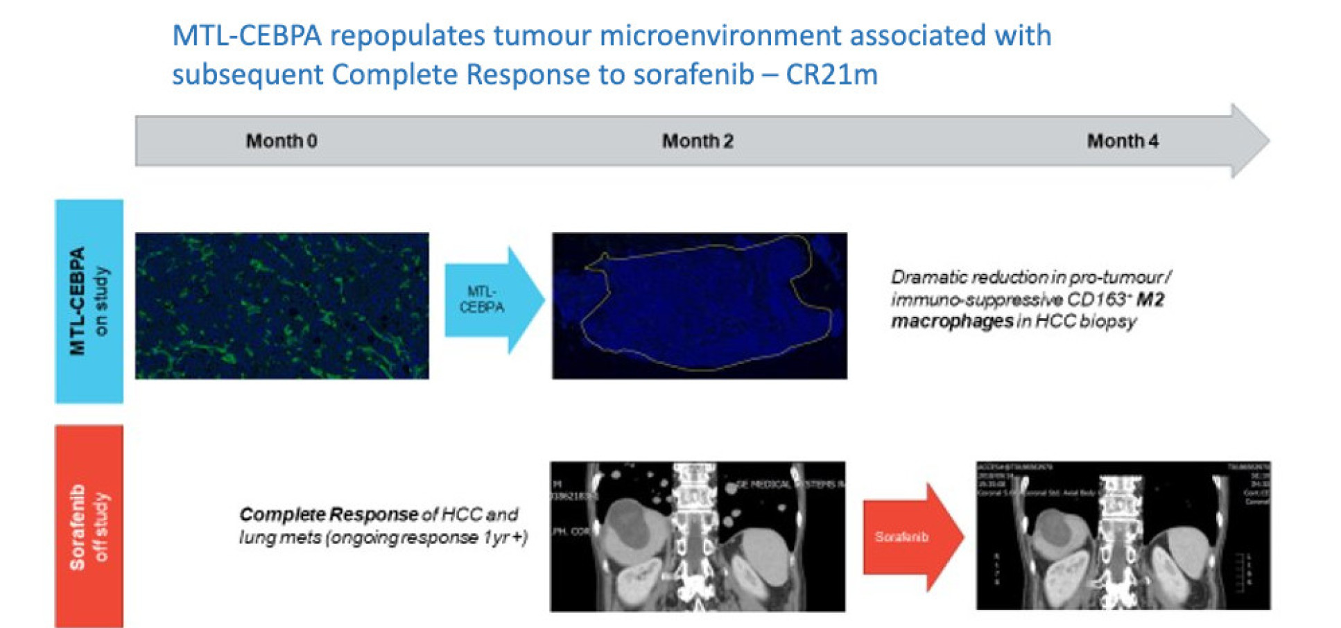MTL-CEBPA repopulates tumour microenvironment associated with subsequent Complete Response to sorafenib – CR21m​