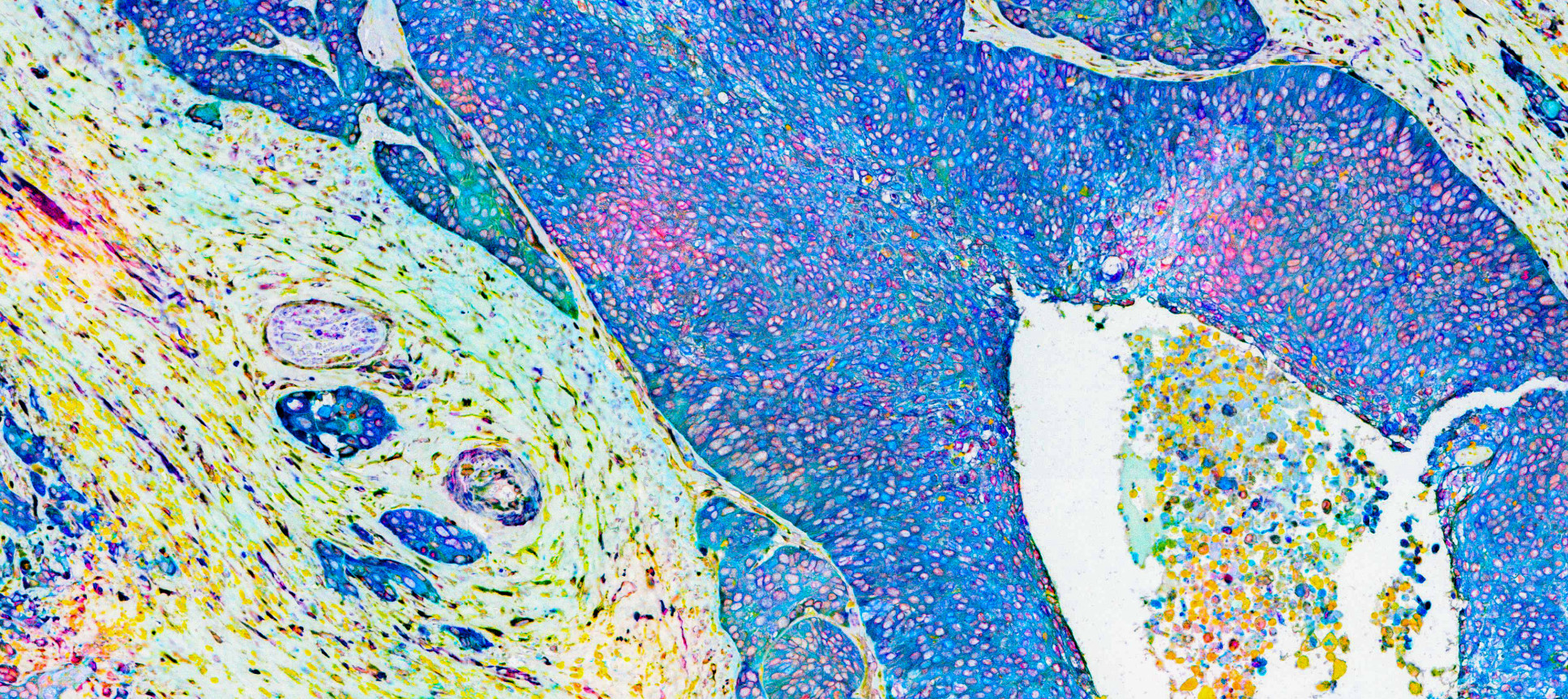 A false color image of deeply shaded cancer cells surrounded by normal tissue