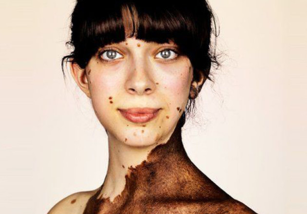 A woman with a skin condition