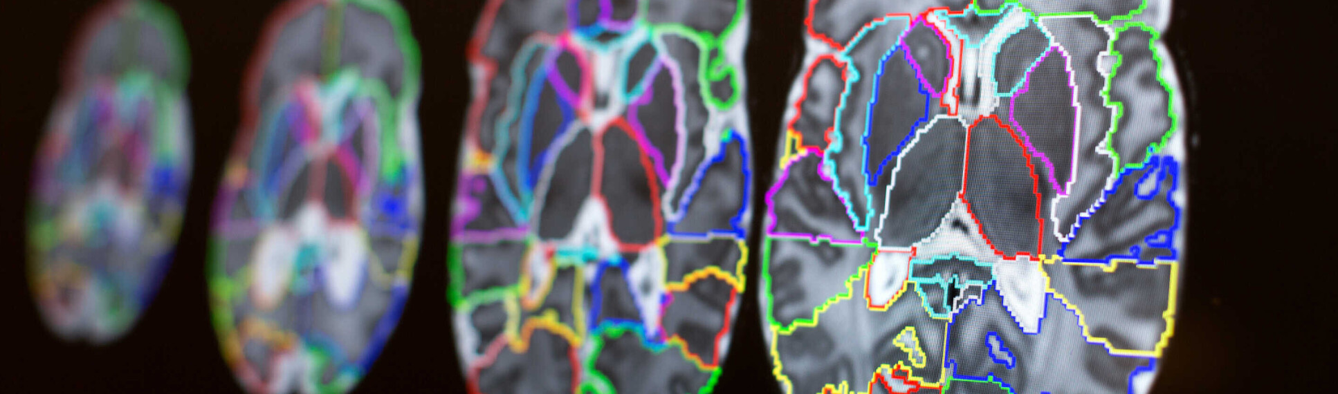 Black and white brain scans, with coloured regions outlined. 