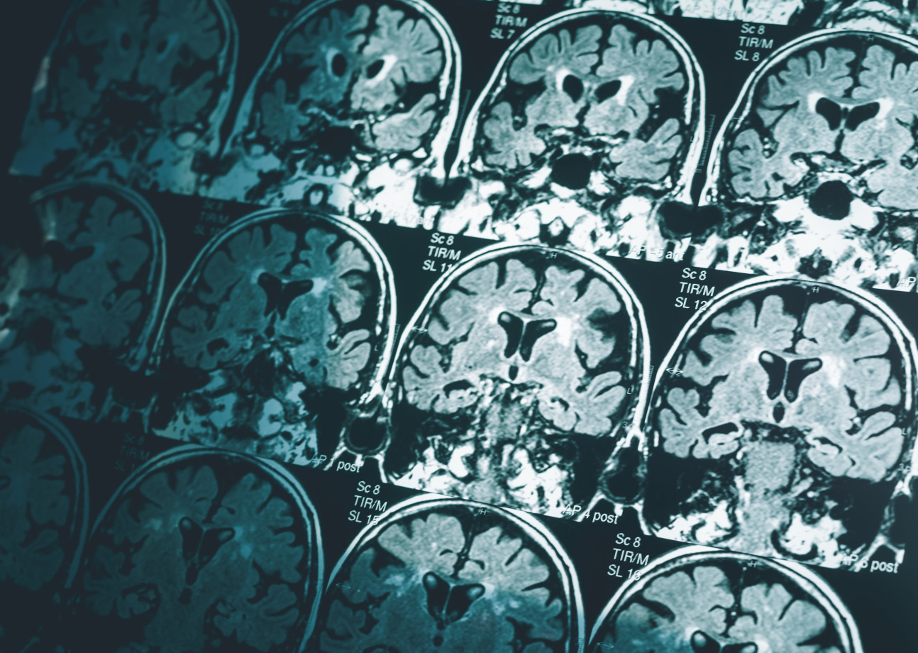 A series of MRI brain scans