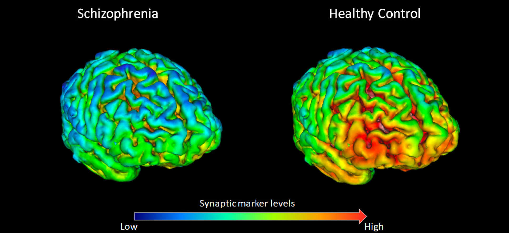 Comparison of schizophrenia versus healthy control brains. Cooler colours on the left show a lack of the protein SV2A