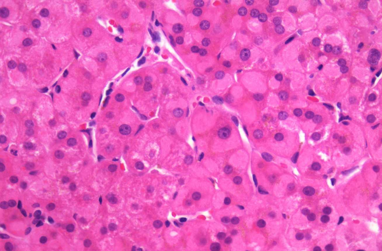 Photomicrograph of a liver infected by hepatitis B