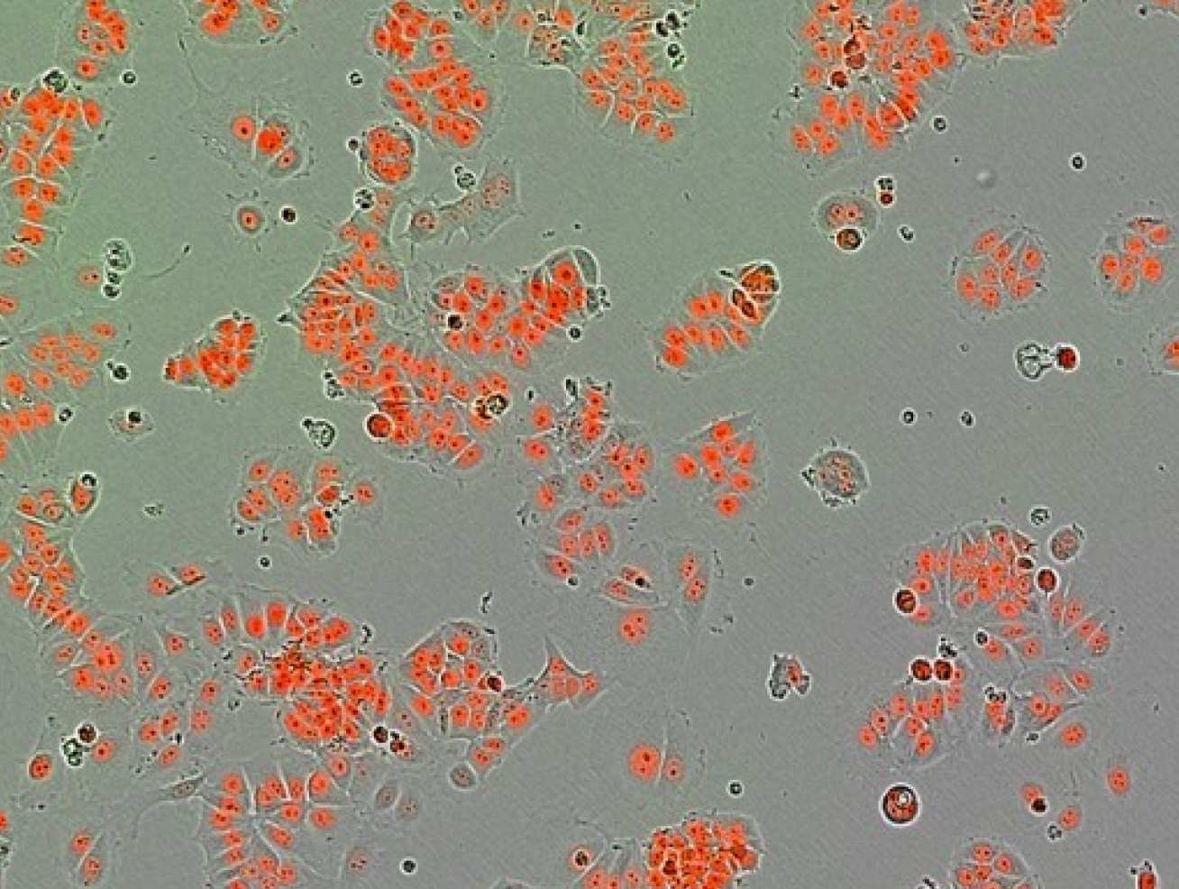 Human breast cancer cells (nucleus shown in red)