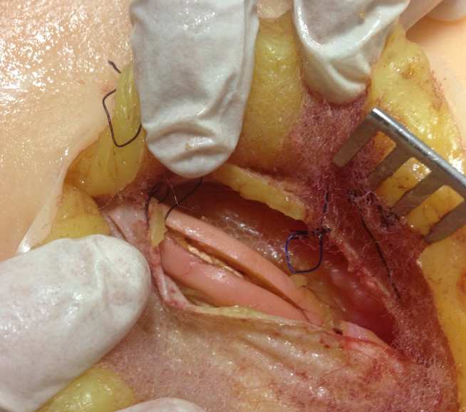 Adult umb hernia repair