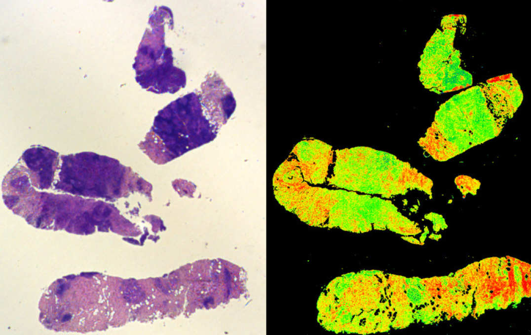 An old cancer biopsy (left) and a quantum Digistain image of the same biopsy (right)