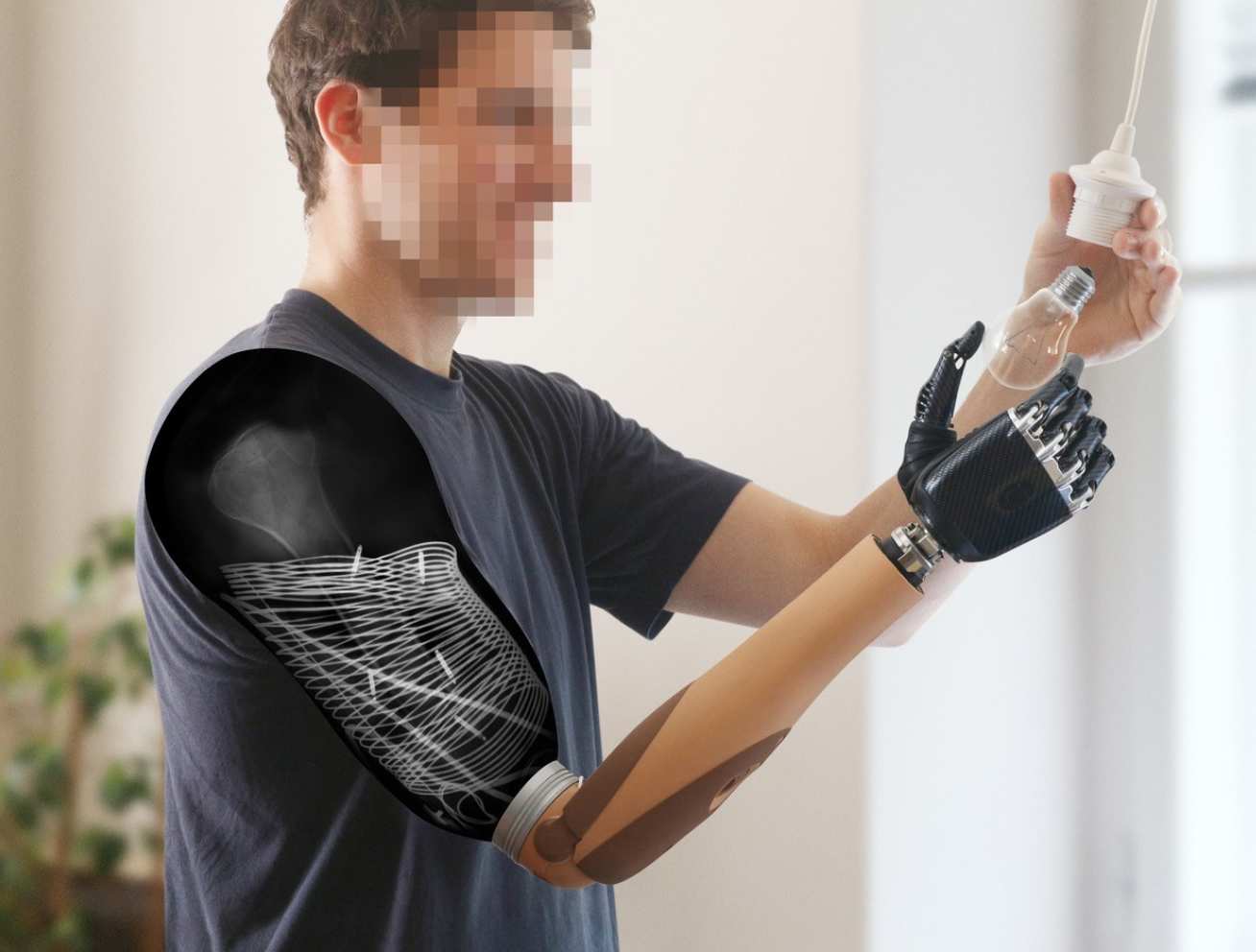 Electrodes in remaining arms give amputees better control of prosthetics, Imperial News