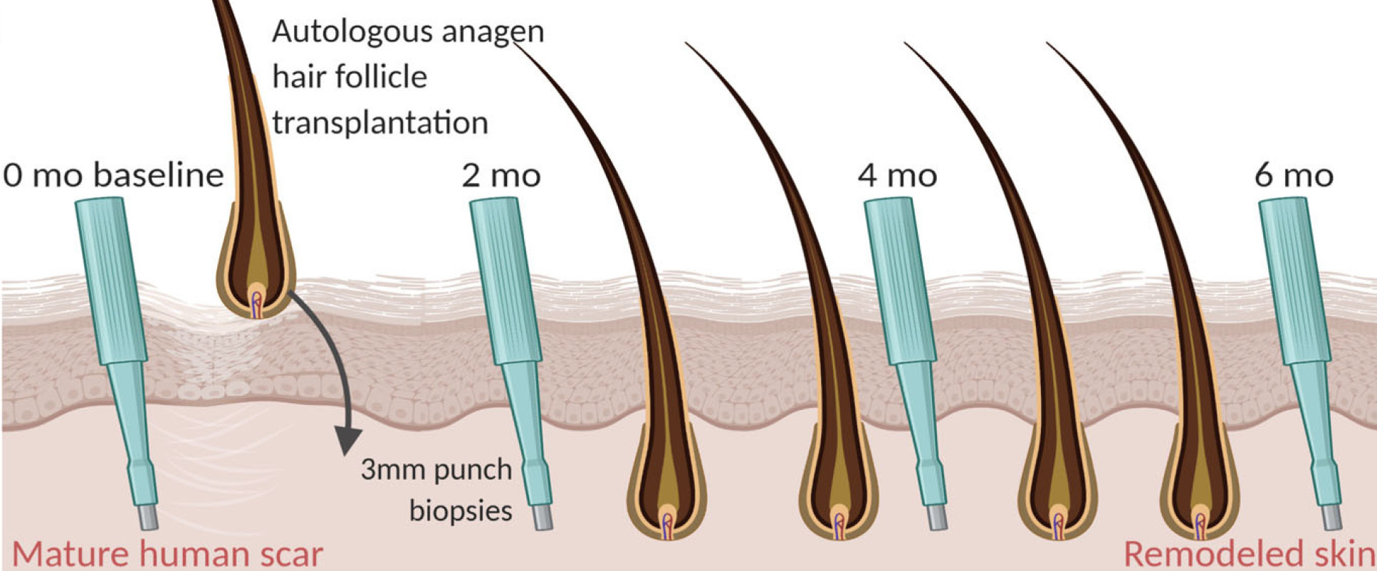Schematic and diagrams of the experimental outline and hypothesis showing skin biopsies at baseline and then 2, 4 and 6 months after hair transplantation.