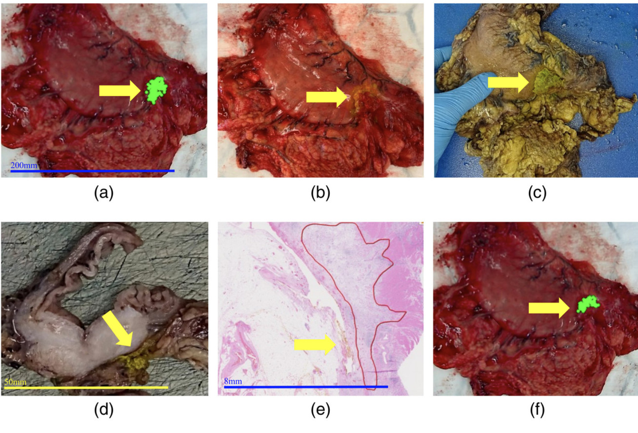 Histopathological analysis of the specimen for purposes of correlation of suspected tumour location.