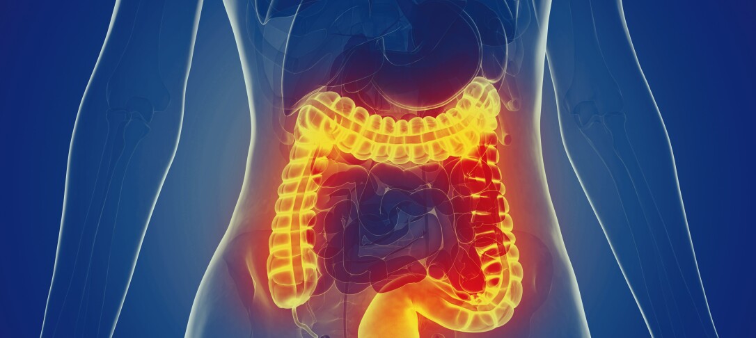 Inflammatory bowel disease illustration