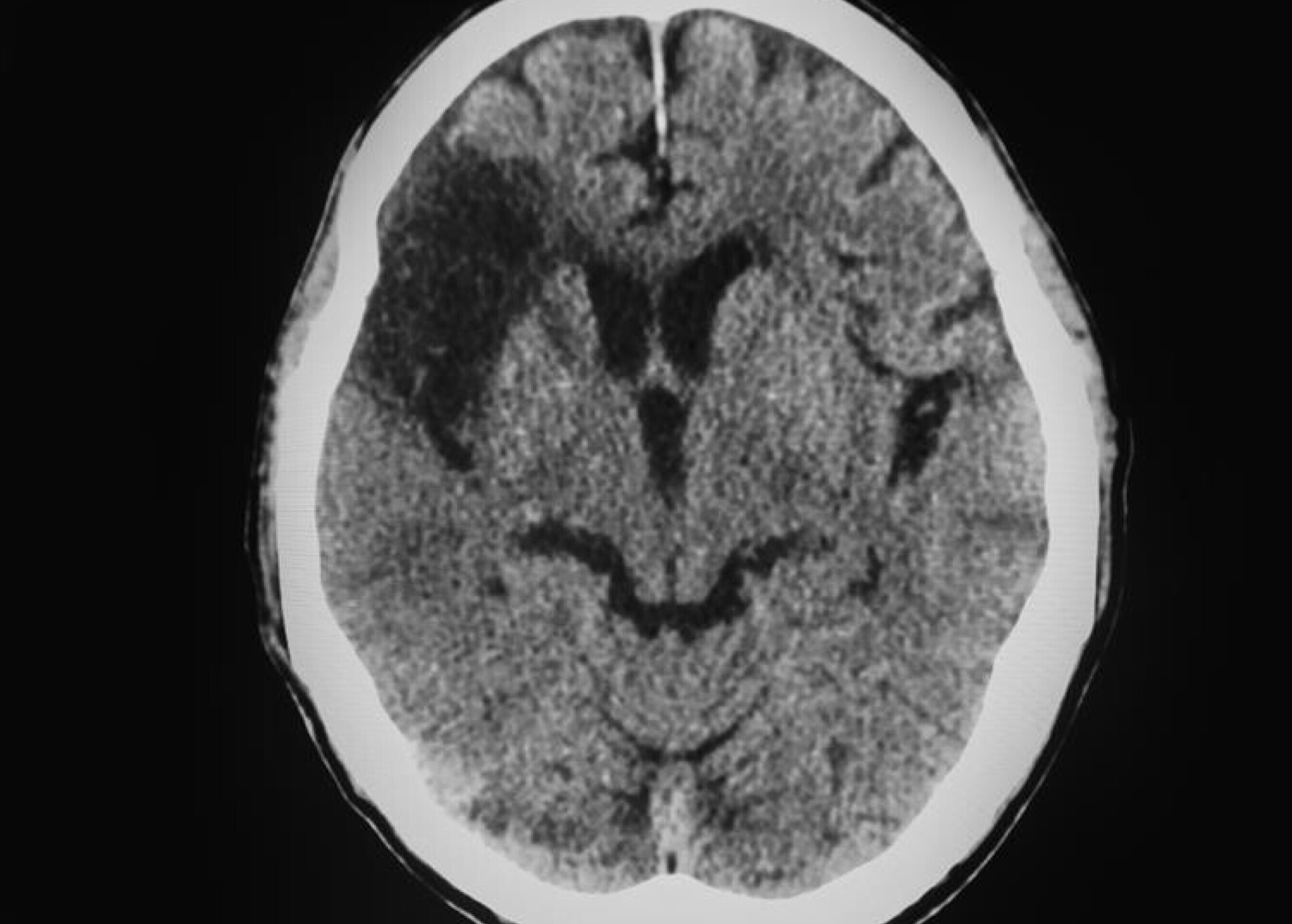 A medical CT scan of the brain