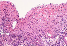 Regular monitoring rather than treatment justified for some cervical lesions