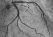Arterial stents help angina patients live symptom free compared with placebo