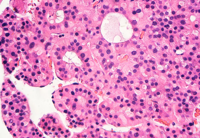 Close up of liver cells with hepatocellular carcinoma (HCC)