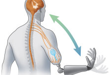 Electrodes in remaining arms give amputees better control of