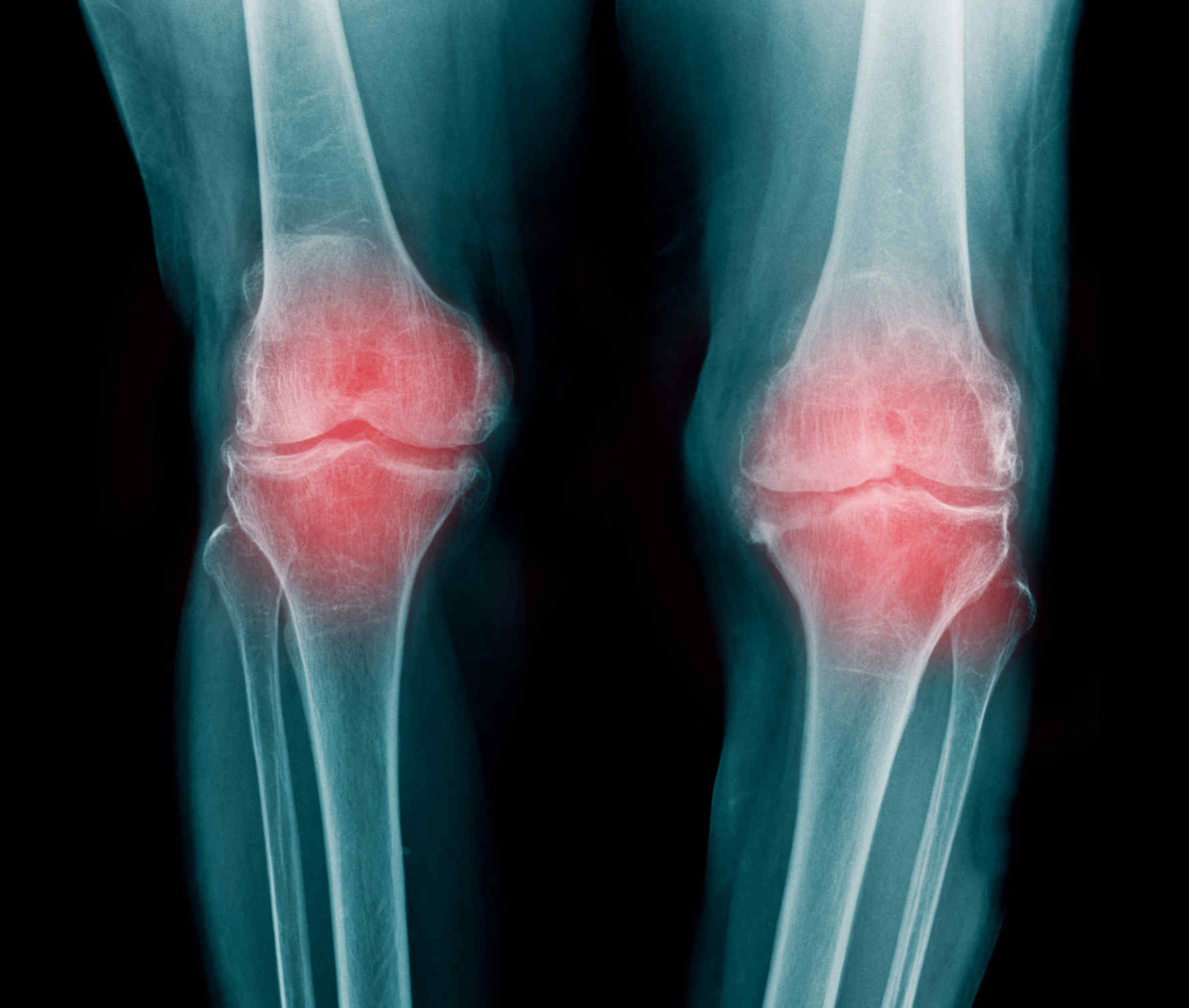 Ревматоидный артрит мышцы. Узуры ревматоидного артрита. Ревматоидный артрит суставы. Ревматоидный артрит коленного сустава. Ревматоидный артрит и остеоартрит.