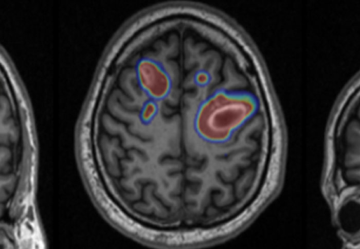 Medical imaging of a brain