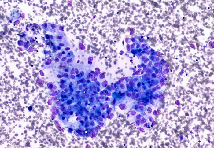 Photomicrograph of cancerous pancreatic cells
