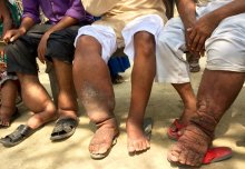 Elephantiasis and river blindness could be eliminated faster with new molecule