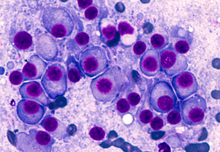 Bone marrow aspirate cytology of multiple myeloma