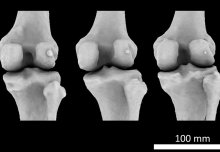 Mystery arthritis-linked knee bone three times more common than 100 years ago