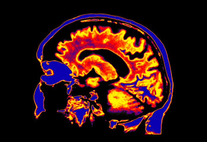 A colourised MRI image of the brain