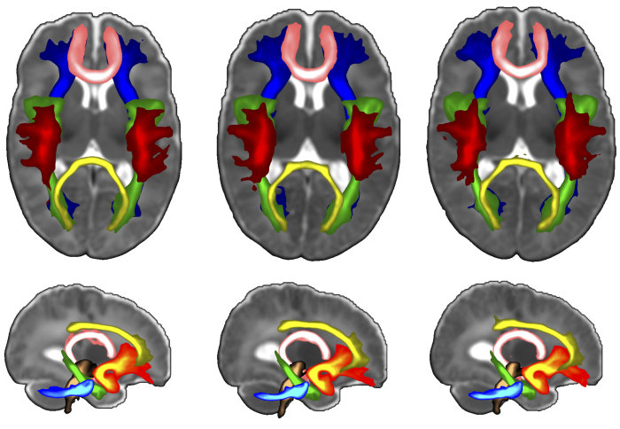 King's College London on LinkedIn: Brain scans reveal exactly why