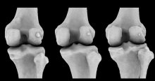 Scan of three knees, each showing different fabella sizes