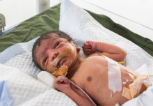 World’s largest study on babies with brain injuries starts in India