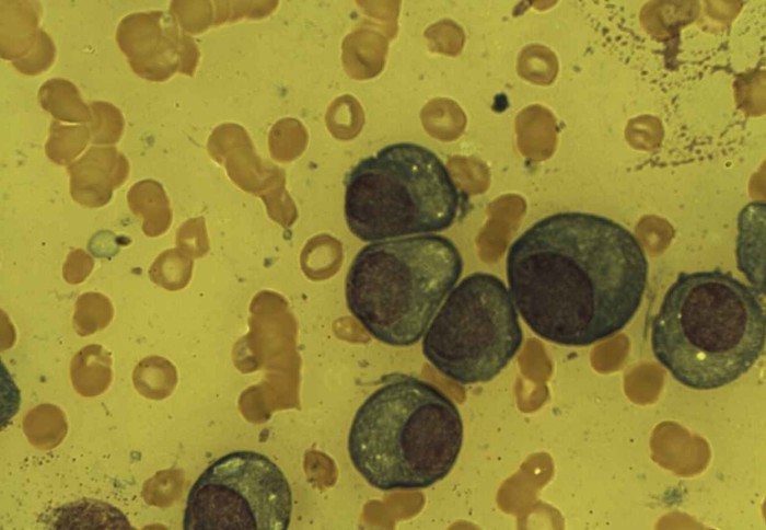 Plasma cells in a bone marrow film in a Multiple Myeloma patient