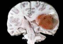 Direction of needle penetration in brain affects drug uptake, finds new study