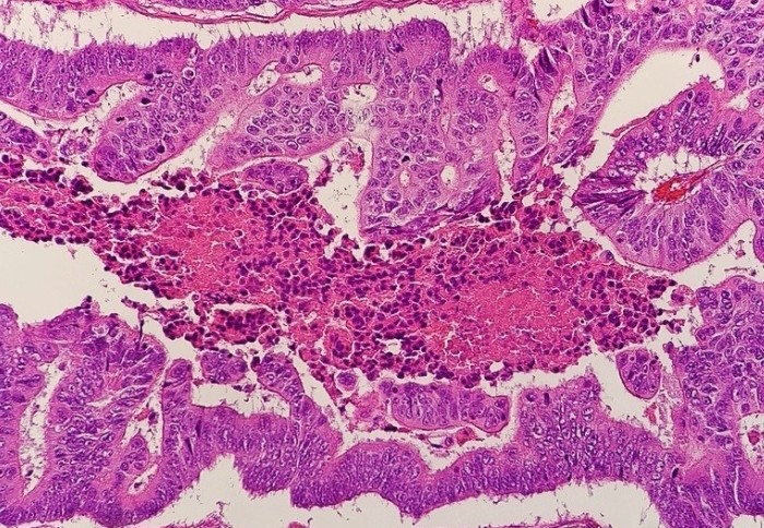 Micrograph of colorectal carcinoma with dirty necrosis