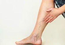 Treatments for varicose veins