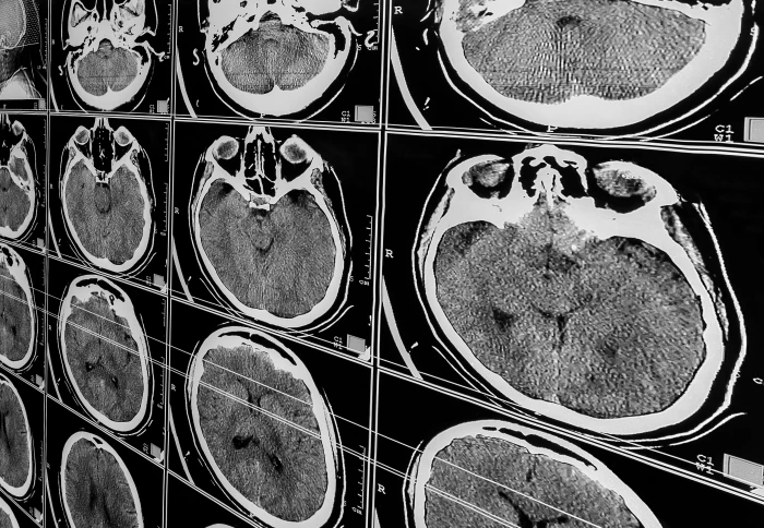 King's College London on LinkedIn: Brain scans reveal exactly why