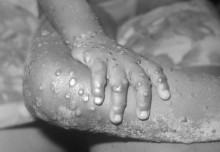 New consortium to tackle monkeypox outbreaks