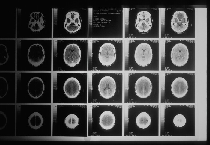 Image of brain scans