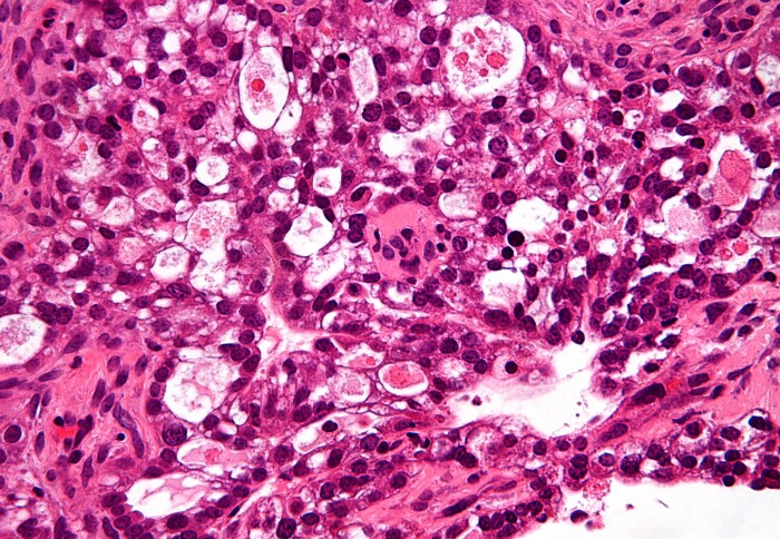 Ovarian clear cell carcinoma