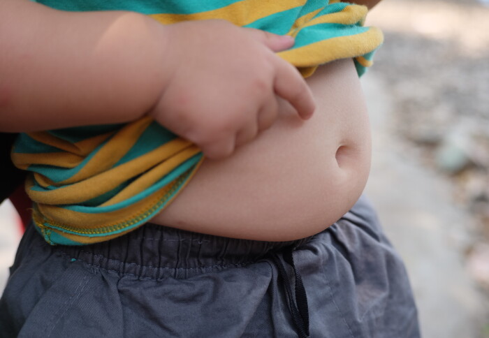 Child with obesity touching stomach