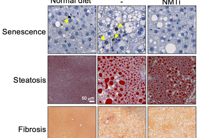 Liver sections showing how the treatment with NMTi reduced cellular senescence, the accumulation of fat (steatosis) and fibrosis in mice fed with Western diet (a model for NASH)