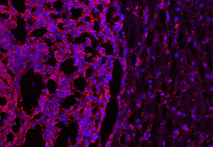 Glioblastoma cells (Brain Tumour Research Centre of Excellence at Imperial College London)