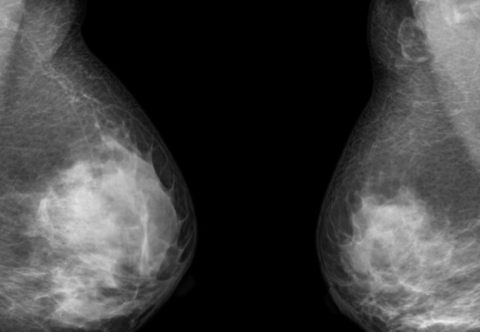Breast cancer scan