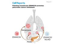 ZDHHC20 promotes cancer immune evasion, a potential target in pancreatic cancer