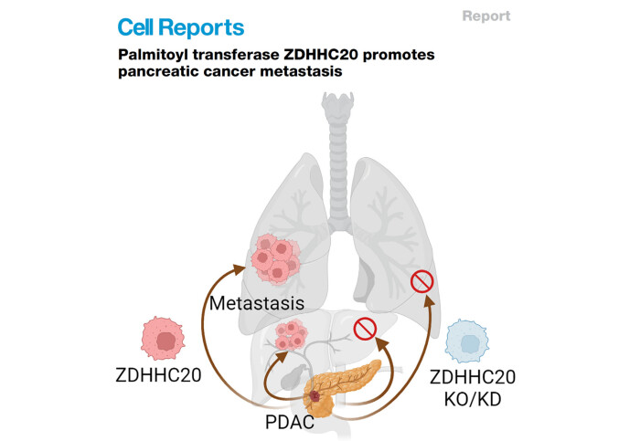 Role of ZDHHC20 in Pancreatic Cancer Metastasis