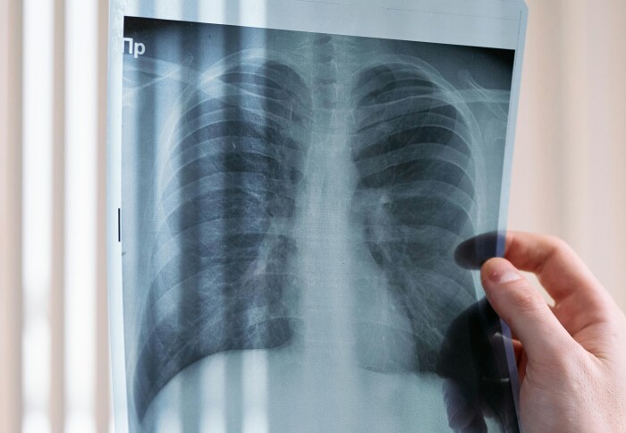 Image of a hand holding an x-ray of a lung