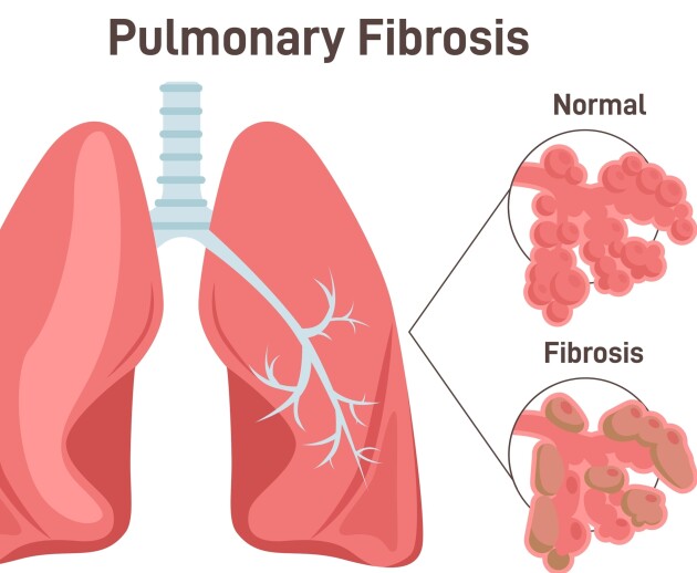 Image to show what scarring in pulmonary fibrosis looks like.