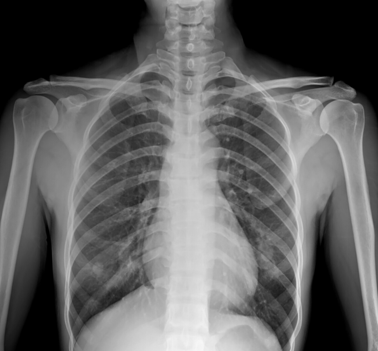 An X-ray image of a human chest