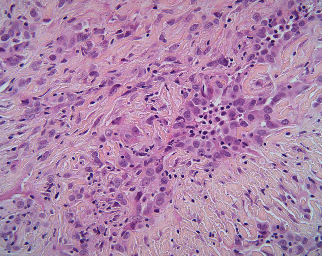 Mesothelioma cancer cells