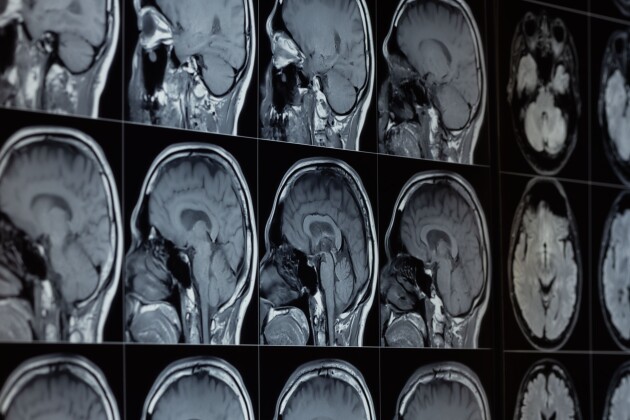 Multiple detailed brain MRI scans 